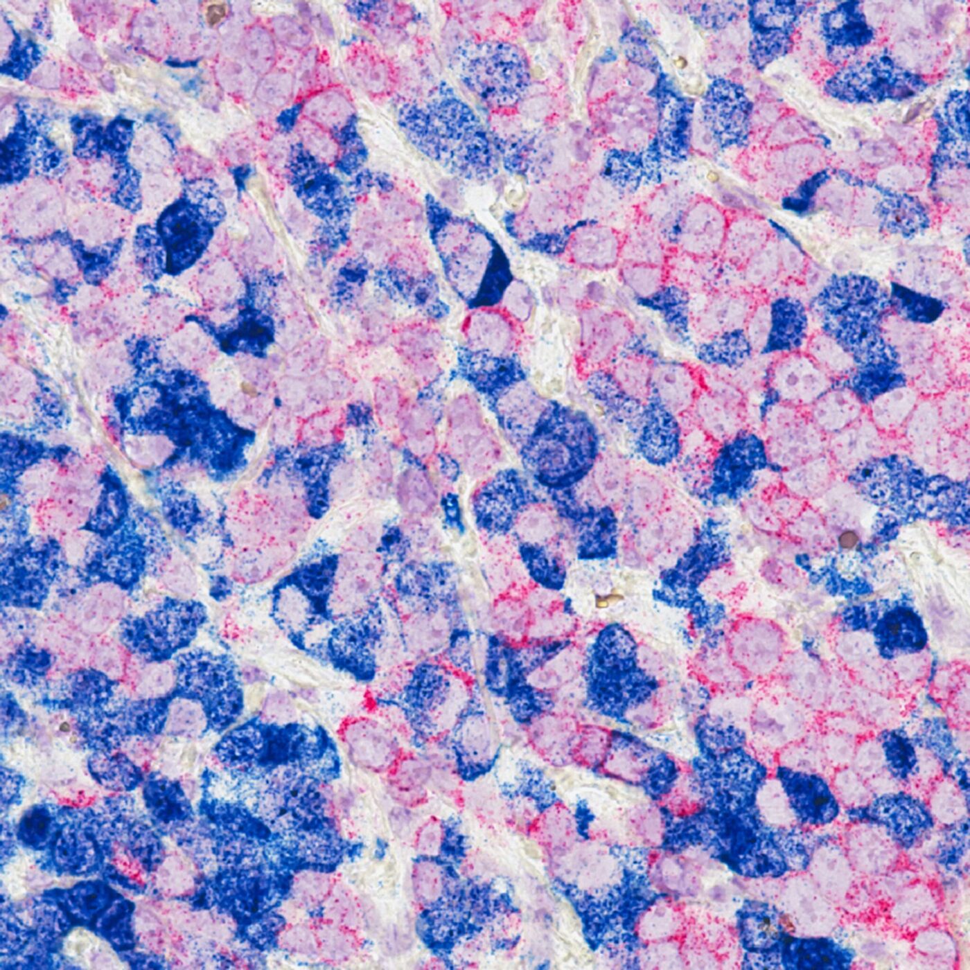 Breast cancer cells colored pink and blue.